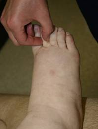 Figure 2a – Positive Stemmer’s sign - right foot